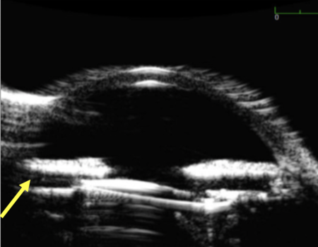 Uveitis-Glaucoma-Hyphema Syndrome - Kahook's Essentials Of Glaucoma Therapy